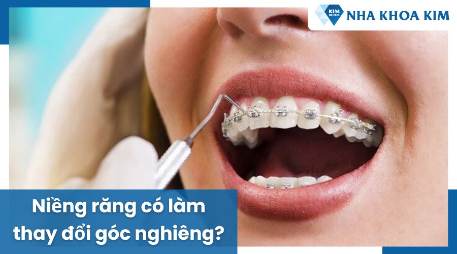 Hình ảnh góc nghiêng trước và sau khi niềng răng