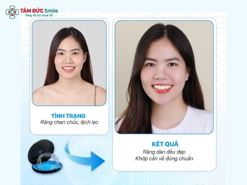 rang-tho-co-nieng-duoc-khong-4