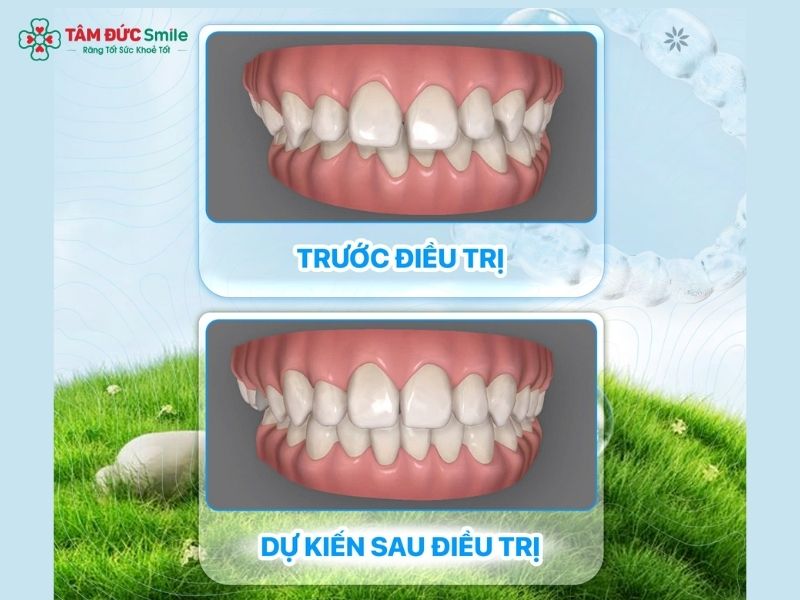 rang-tho-co-nieng-duoc-khong-8