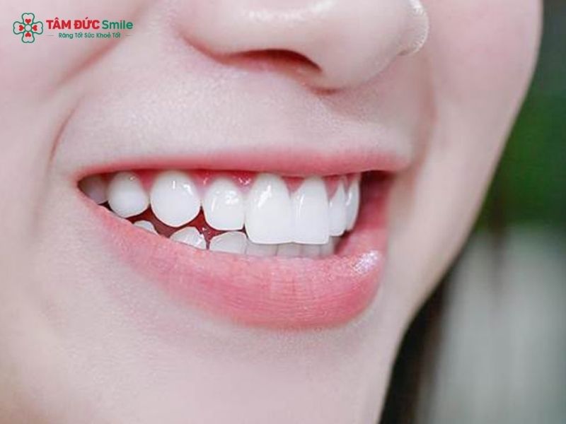 Răng thỏ có niềng được không? Giải pháp giữ nét duyên, cải thiện khớp cắn