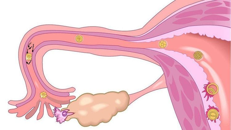 Cắt hết buồng trứng ảnh hưởng gì tới đời sống tình dục?