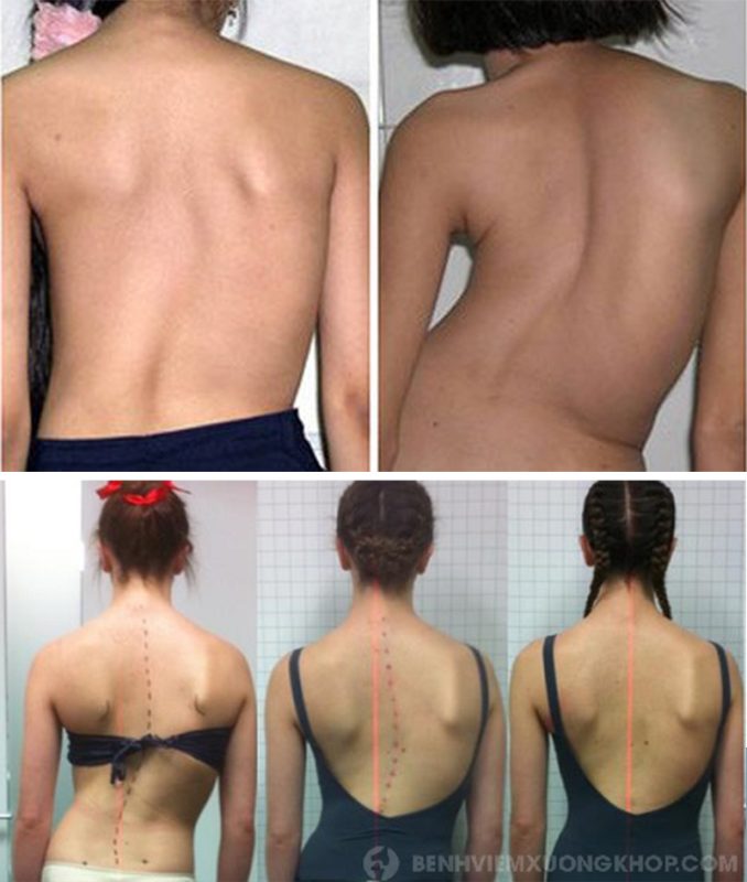 Cong vẹo cột sống ở trẻ - Nguyên nhân và cách khắc phục