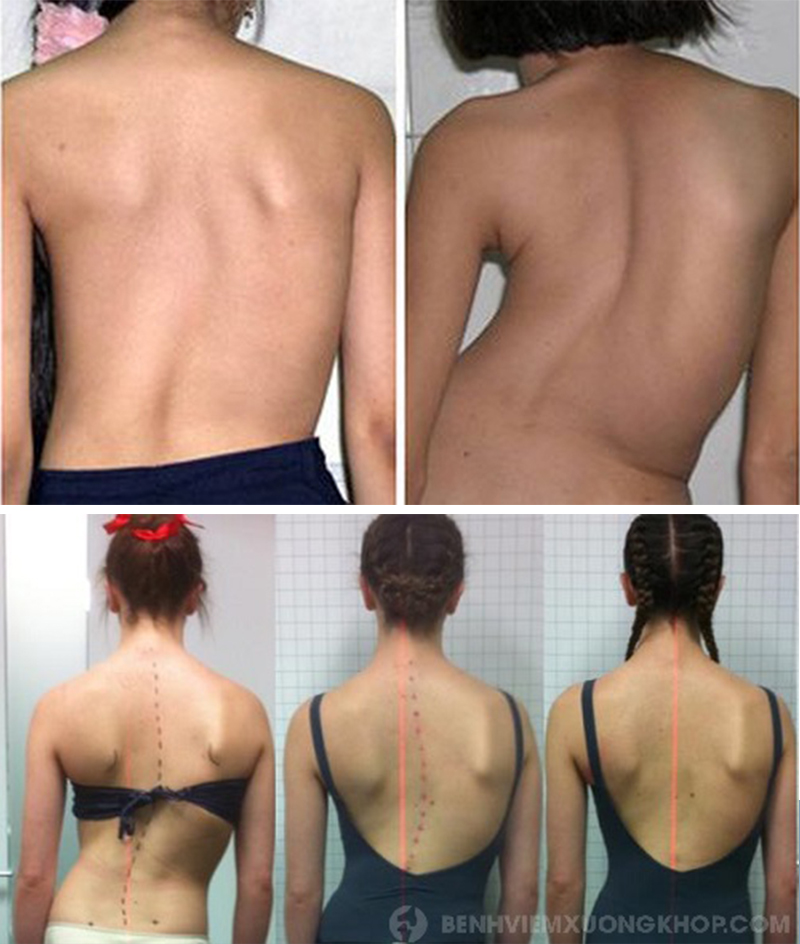 trẻ ở độ tuổi thanh thiếu niên bị cong vẹo cột sống