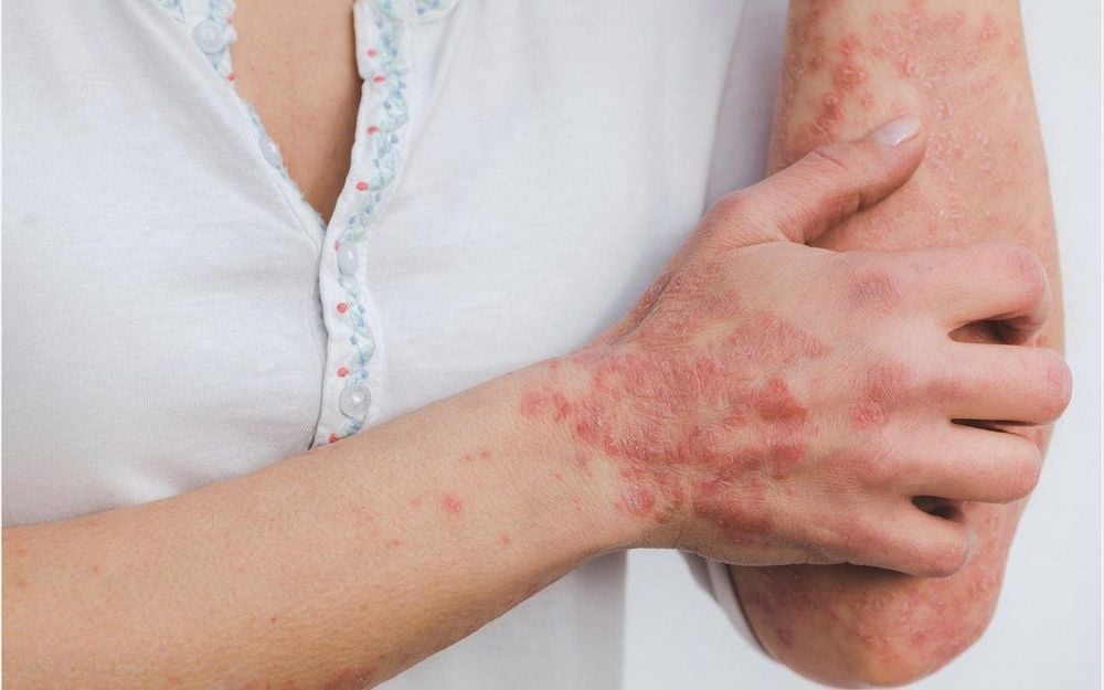 Rượu có khả năng làm suy yếu các đáp ứng miễn dịch có thể dẫn đến bệnh vẩy nến
