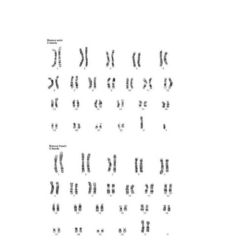 Các bệnh do bất thường nhiễm sắc thể gây ra