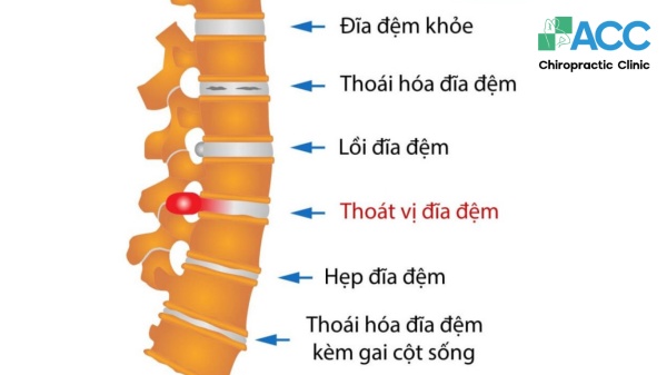 Thoát vị đĩa đệm: Nguyên nhân, triệu chứng và cách điều trị