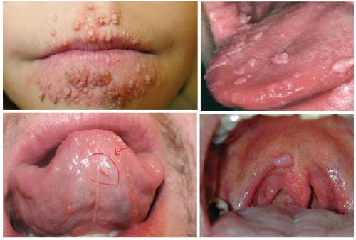 hình ảnh bệnh sùi mào gà ở vùng miệng