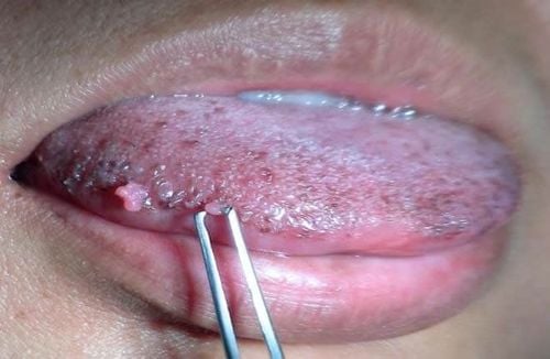 Hình ảnh gai lưỡi bình thường và có bệnh lý ở nam và nữ giới? cách chữa