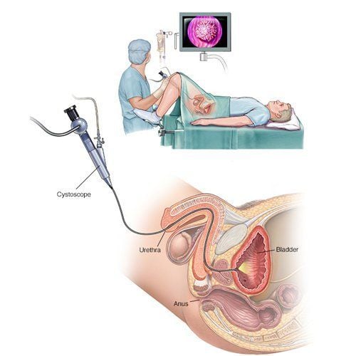 Bệnh phì đại tuyến tiền liệt lành tính được chẩn đoán bằng phương pháp nội soi bàng quang