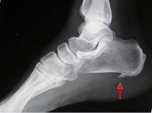 Chụp phim X quang vùng gót chân để phát hiện hình ảnh gai xương gót chân trên X quang