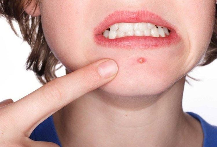 Nếu mụn bọc ở cằm ở tình trạng nhẹ có thể điều trị tại nhà và không nên nặn chúng