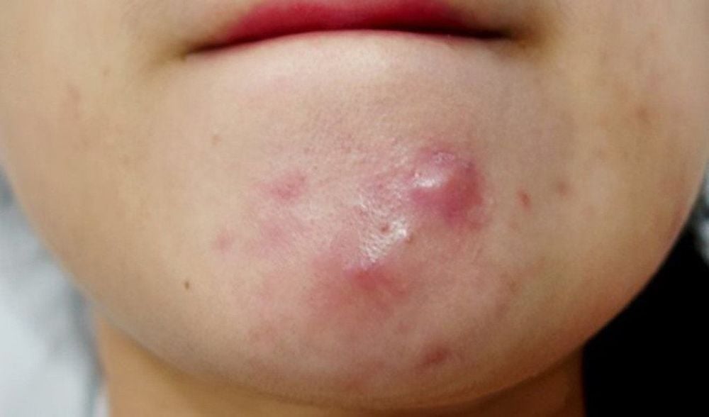Mụn bọc ở cằm có nên nặn không?
