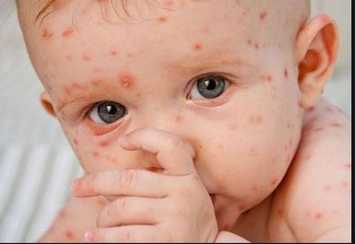 Bổ sung vitamin A có thể giúp điều trị bệnh sởi ở trẻ em