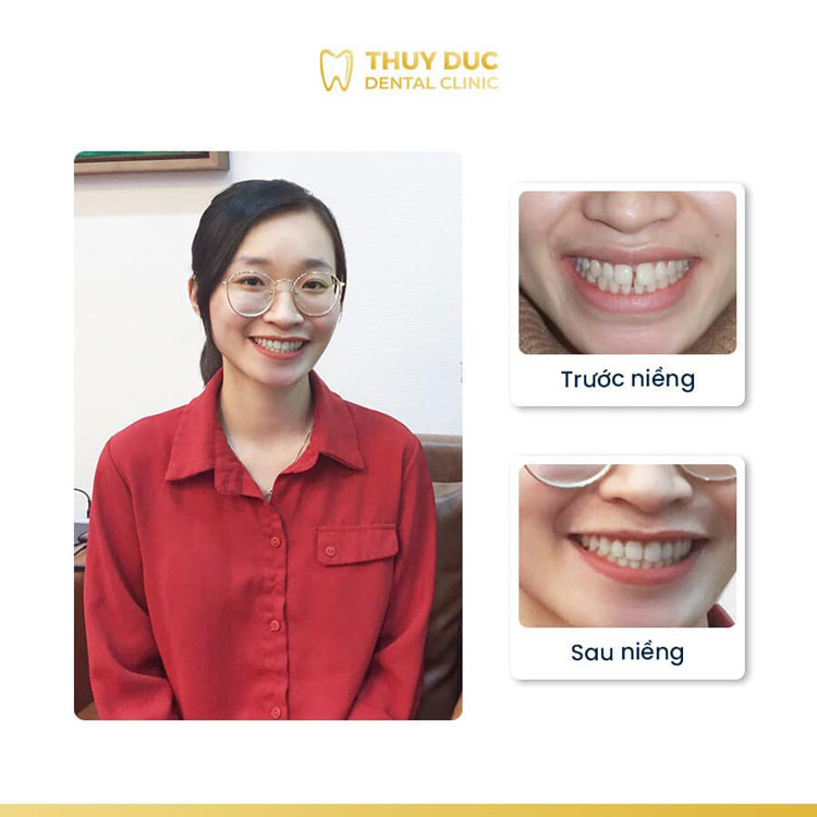 Hình ảnh khách hàng trước và sau khi niềng răng thưa 2