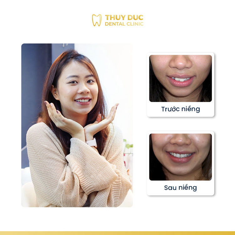 Hình ảnh trước - sau khi niềng răng xô lệch, chen chúc, khấp khểnh 2