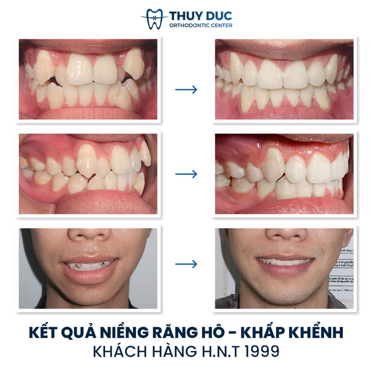 Hình ảnh trước - sau khi niềng răng xô lệch, chen chúc, khấp khểnh 3