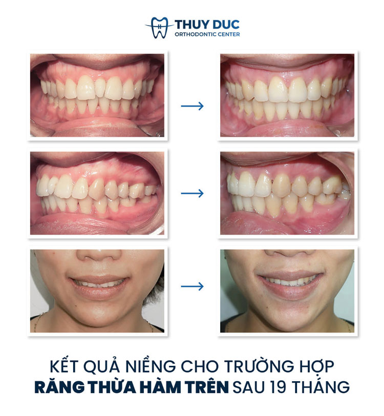 Hình ảnh trước - sau khi niềng răng xô lệch, chen chúc, khấp khểnh 4