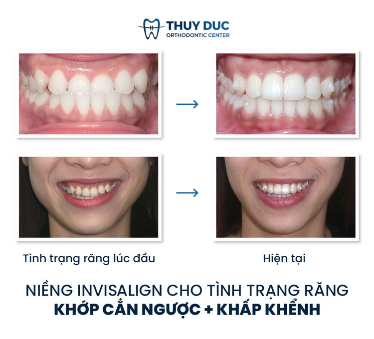 Hình ảnh trước - sau khi niềng răng móm 1