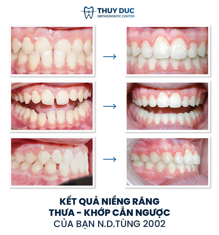 Hình ảnh trước - sau khi niềng răng móm 2