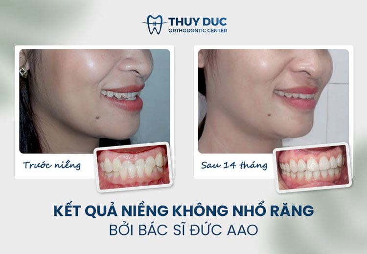 Hình ảnh trước - sau khi niềng răng móm 3