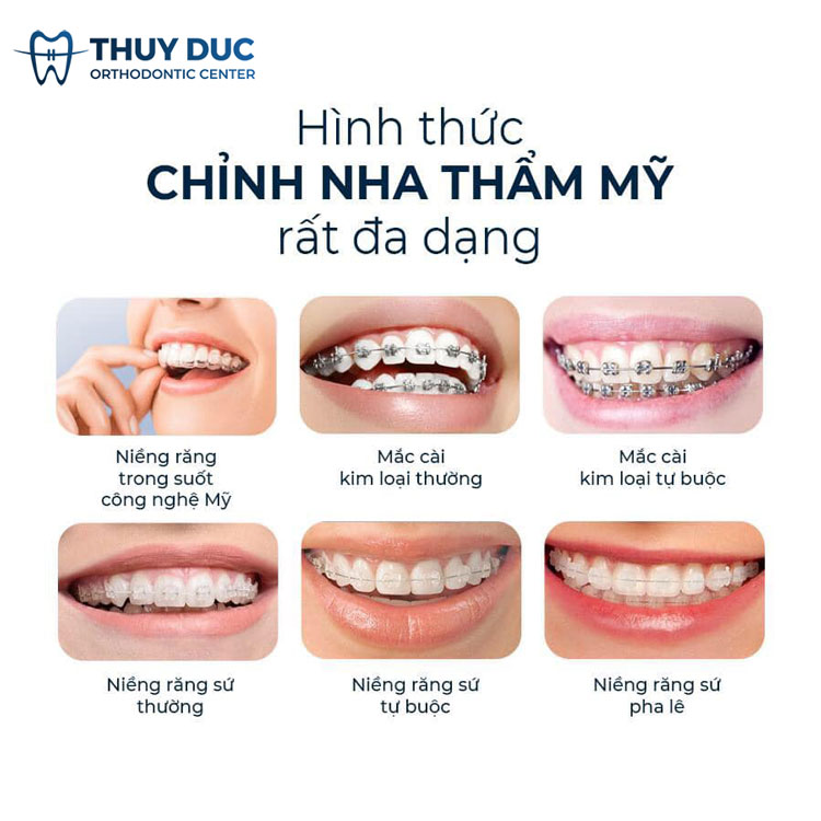 Hình ảnh các phương pháp niềng răng tại Nha khoa Thúy Đức hiện nay 1