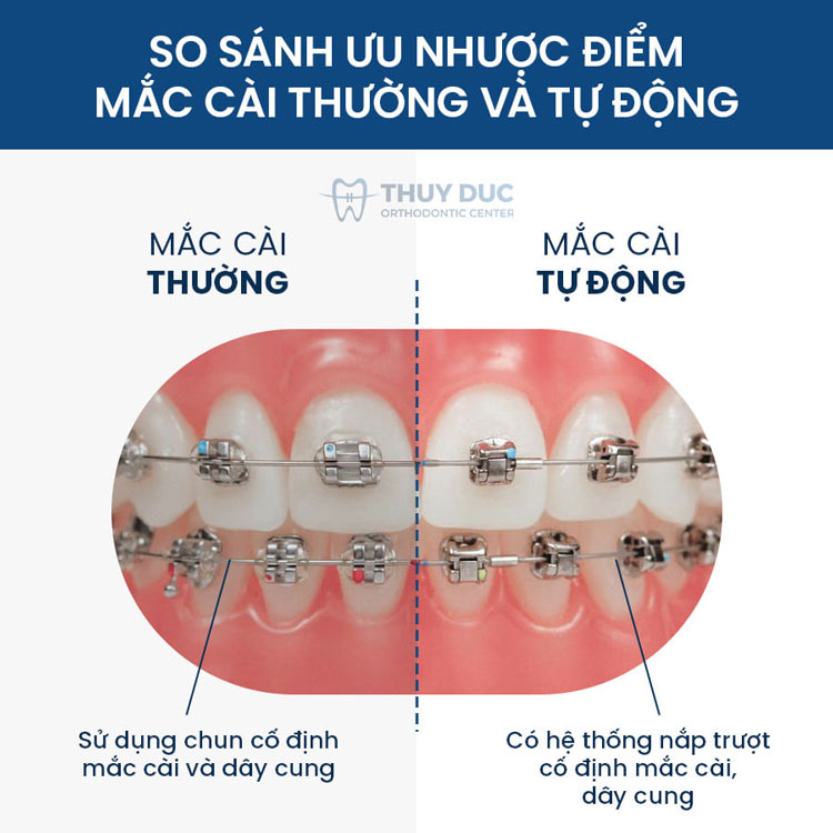 Hình ảnh niềng răng với mắc cài kim loại 1