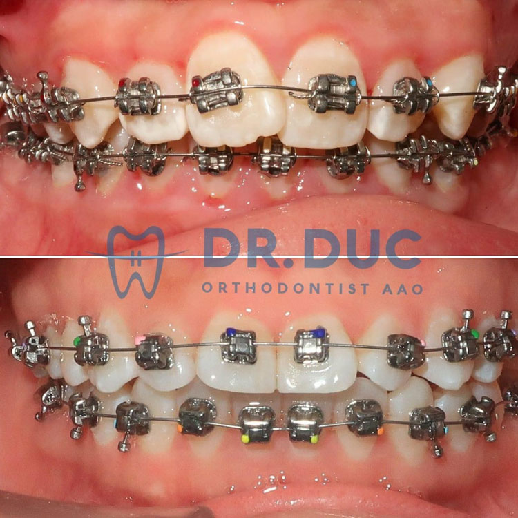 Hình ảnh niềng răng với mắc cài kim loại 2