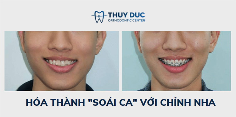 Hình ảnh niềng răng với mắc cài kim loại 3