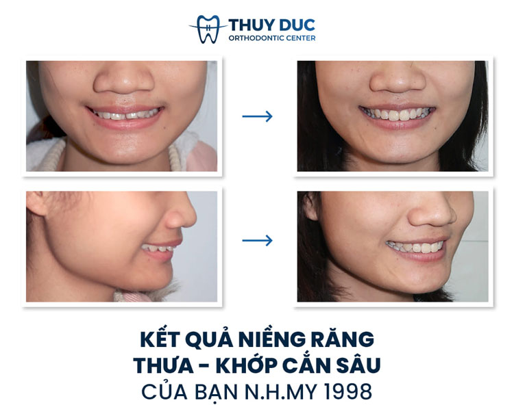 Hình ảnh khách hàng trước và sau khi niềng răng thưa 3