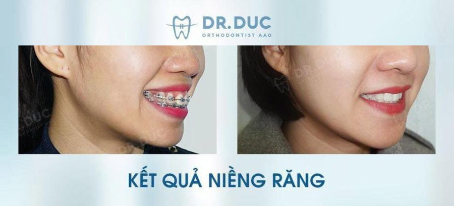 Hình ảnh niềng răng với mắc cài kim loại 4