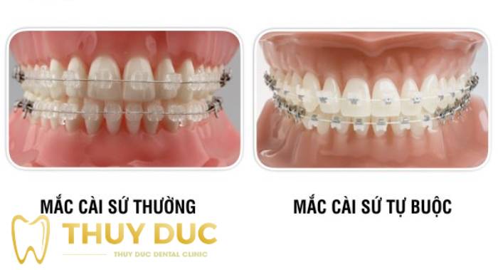 Niềng răng mắc cài sứ 1