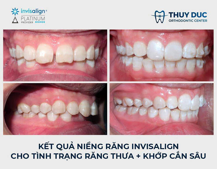 Niềng răng trong suốt Invisalign 2