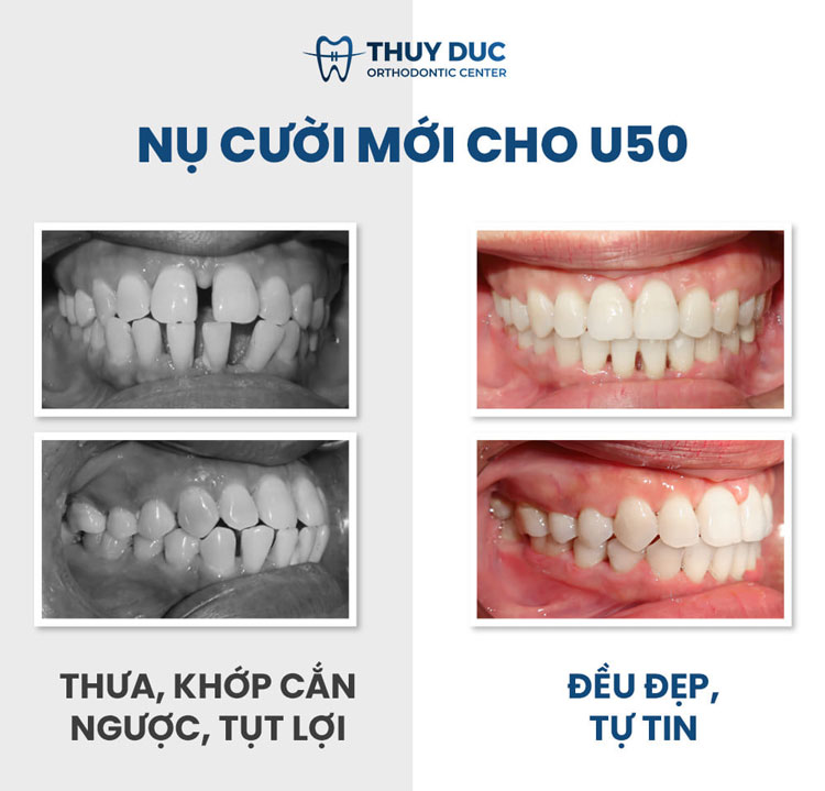 Hình ảnh khách hàng trước và sau khi niềng răng thưa 4