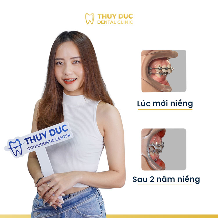 Hình ảnh khách hàng trước và sau khi niềng răng hô, vẩu 1