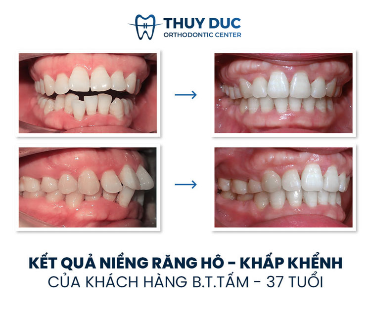 Hình ảnh khách hàng trước và sau khi niềng răng hô, vẩu 2