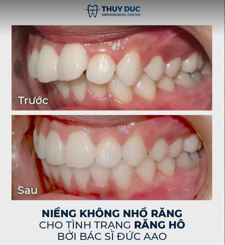 Hình ảnh khách hàng trước và sau khi niềng răng hô, vẩu 3