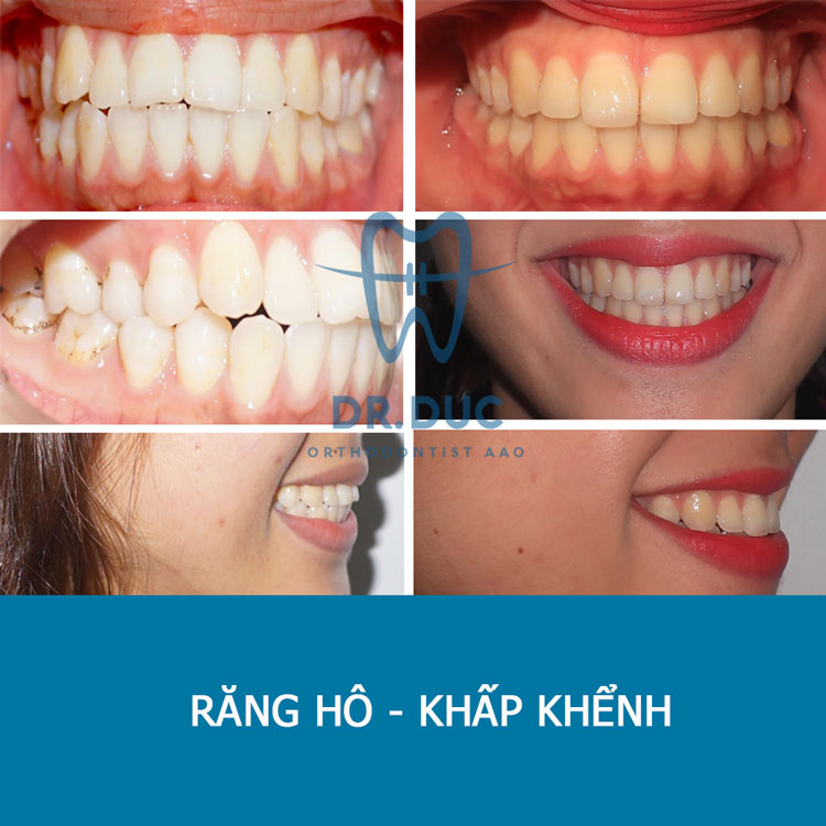 Hình ảnh khách hàng trước và sau khi niềng răng hô, vẩu 4