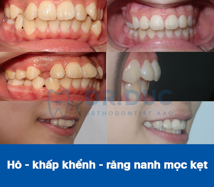 Hình ảnh khách hàng trước và sau khi niềng răng hô, vẩu 5