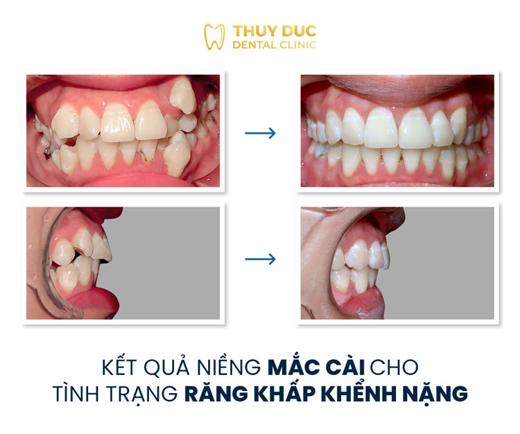 Hình ảnh trước - sau khi niềng răng xô lệch, chen chúc, khấp khểnh 1