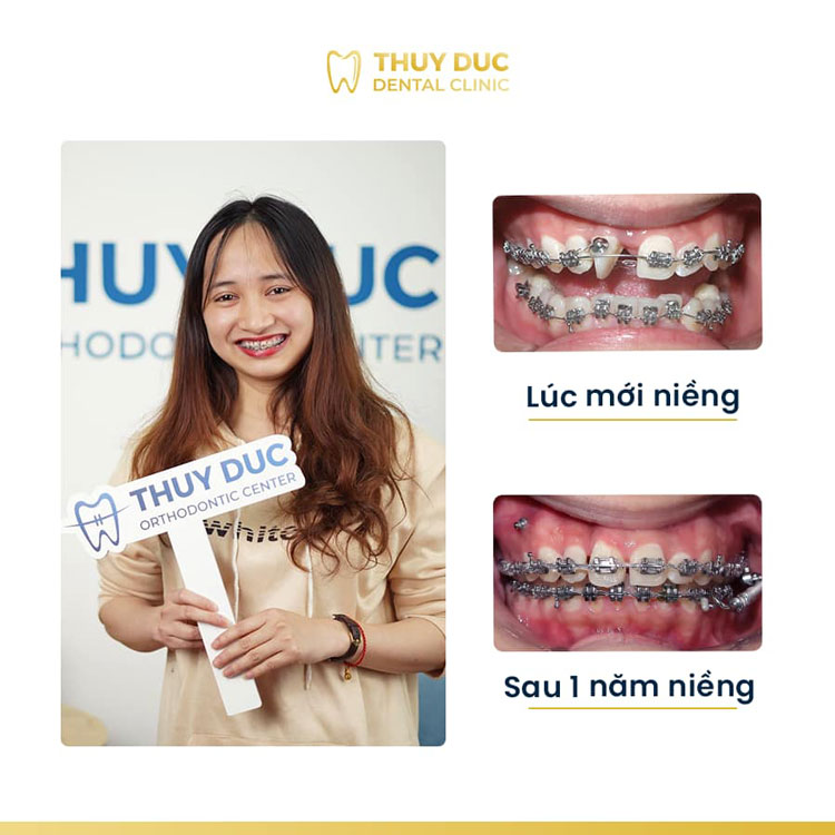 Loạt ảnh thay đổi trước và sau khi niềng răng tại Thuý Đức
