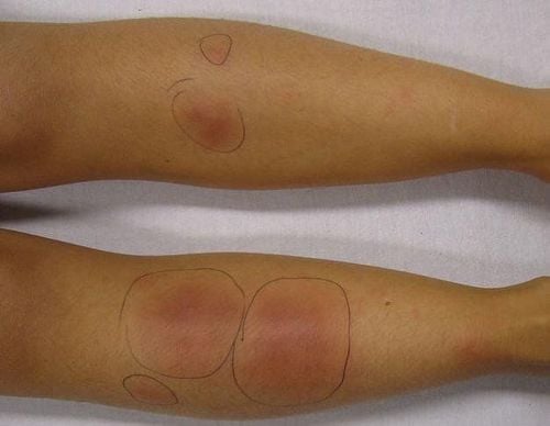 Vùng da bị tổn thương có xu hướng dày lên