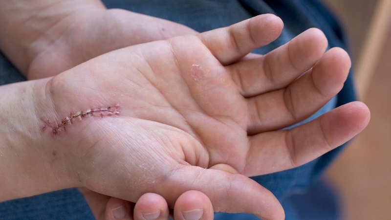 Bị sẹo kiêng ăn gì? Lời khuyên dinh dưỡng cho từng loại sẹo