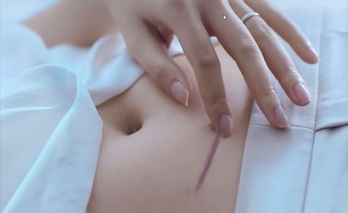 Chỉ tự tiêu được dùng nhiều để khâu những vết thương sau phẫu thuật