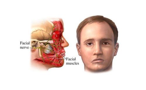 Miệng méo là một triệu chứng phổ biến khi bị liệt mặt thần kinh