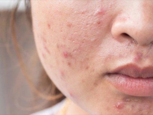 Xuất hiện nhiều mụn trứng cá, đặc biệt ở mặt, ngực và lưng