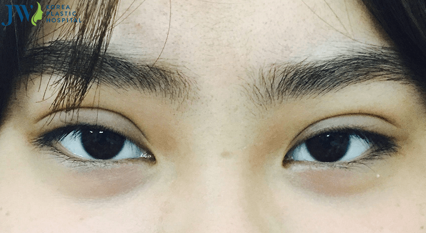 Mắt buồn là gì