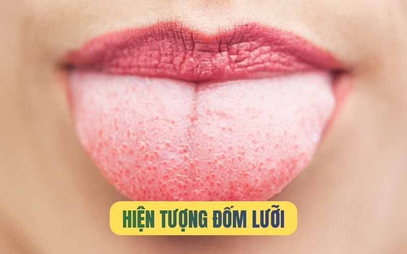 Đốm lưỡi là gì? Nguyên nhân và các dấu hiệu nhận biết