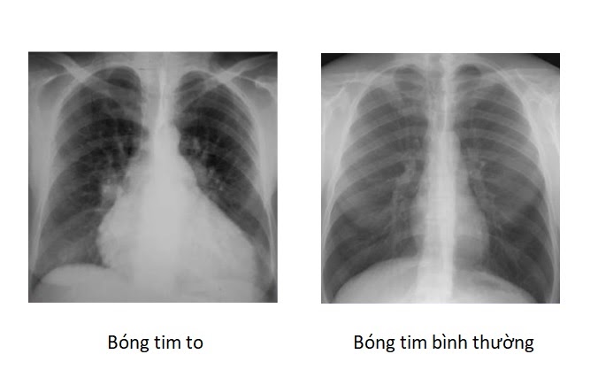 ️ Bóng tim to trên X Quang tim phổi: Bạn cần biết thêm gì?