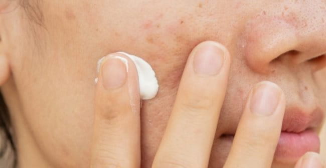Sử dụng thuốc trị tăng sắc tố da ở mặt