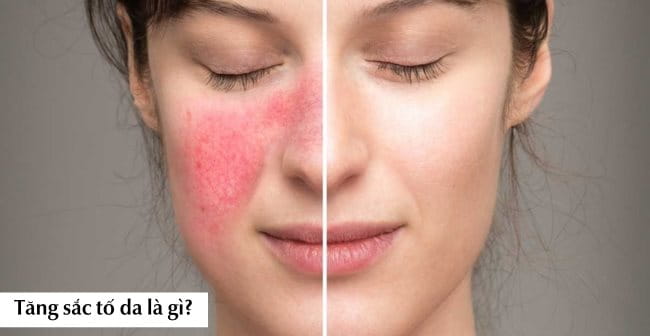 Tăng Sắc Tố Da: Nguyên Nhân, Cách Điều Trị Hiệu Quả